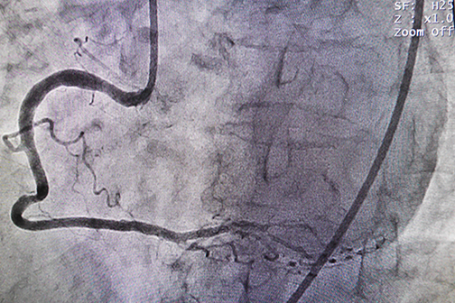 angiogram